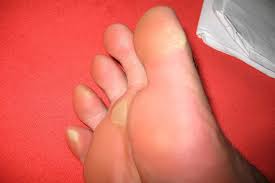 All to Know About Foot Callus Treatment