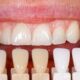 5 Reasons To Consider Same-Day Crowns for Your Smile